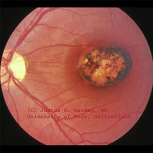 Toxoplasmose – Berner Augenklinik
